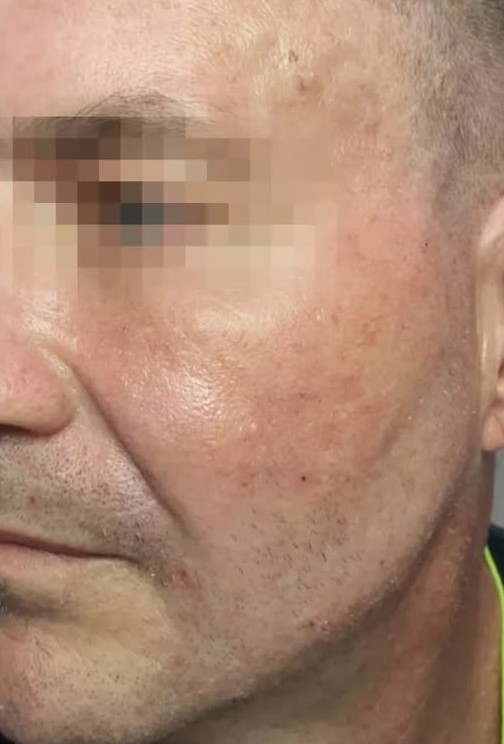 After Collagen