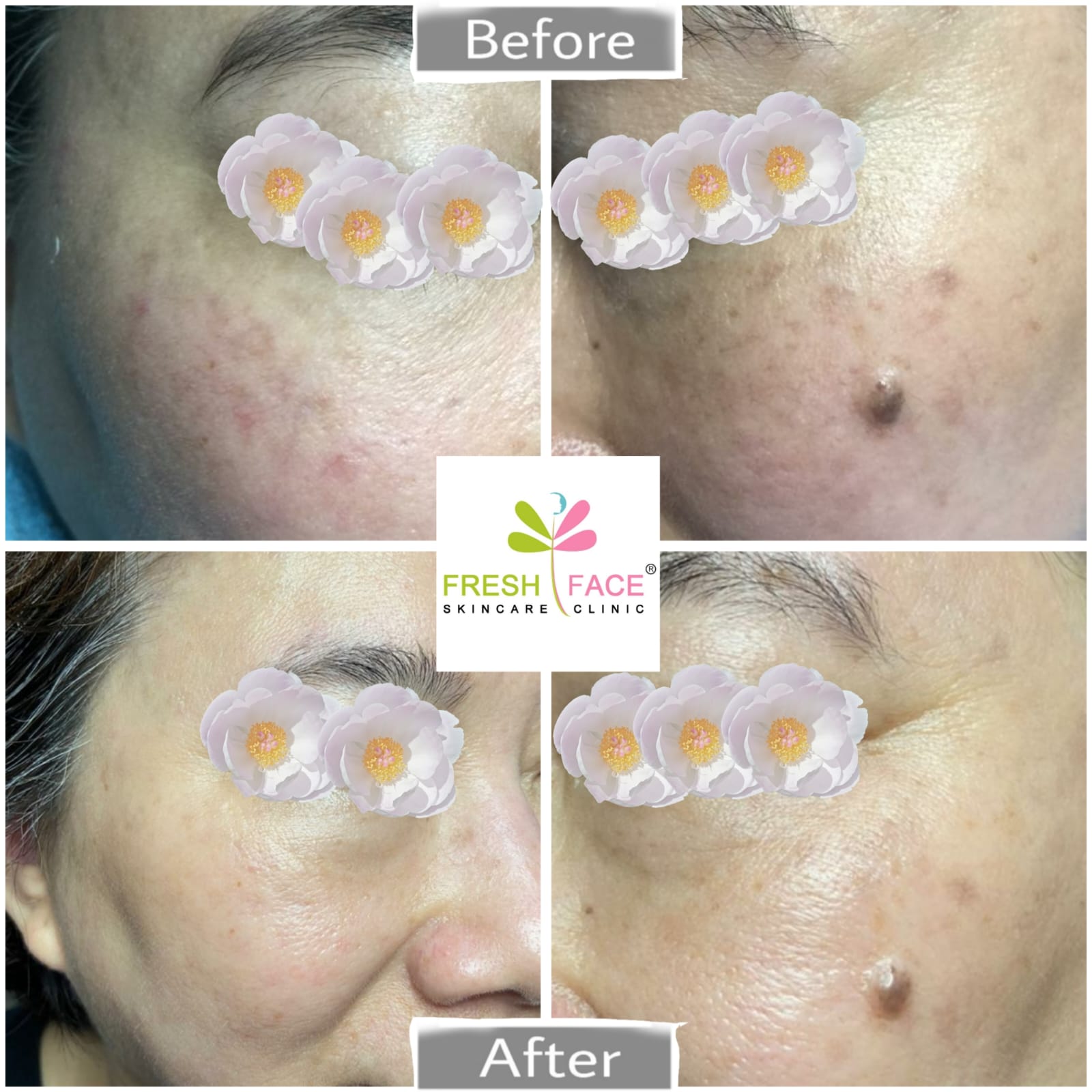 Flek Treatment