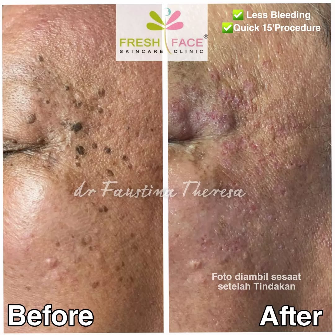 Kutil Removal