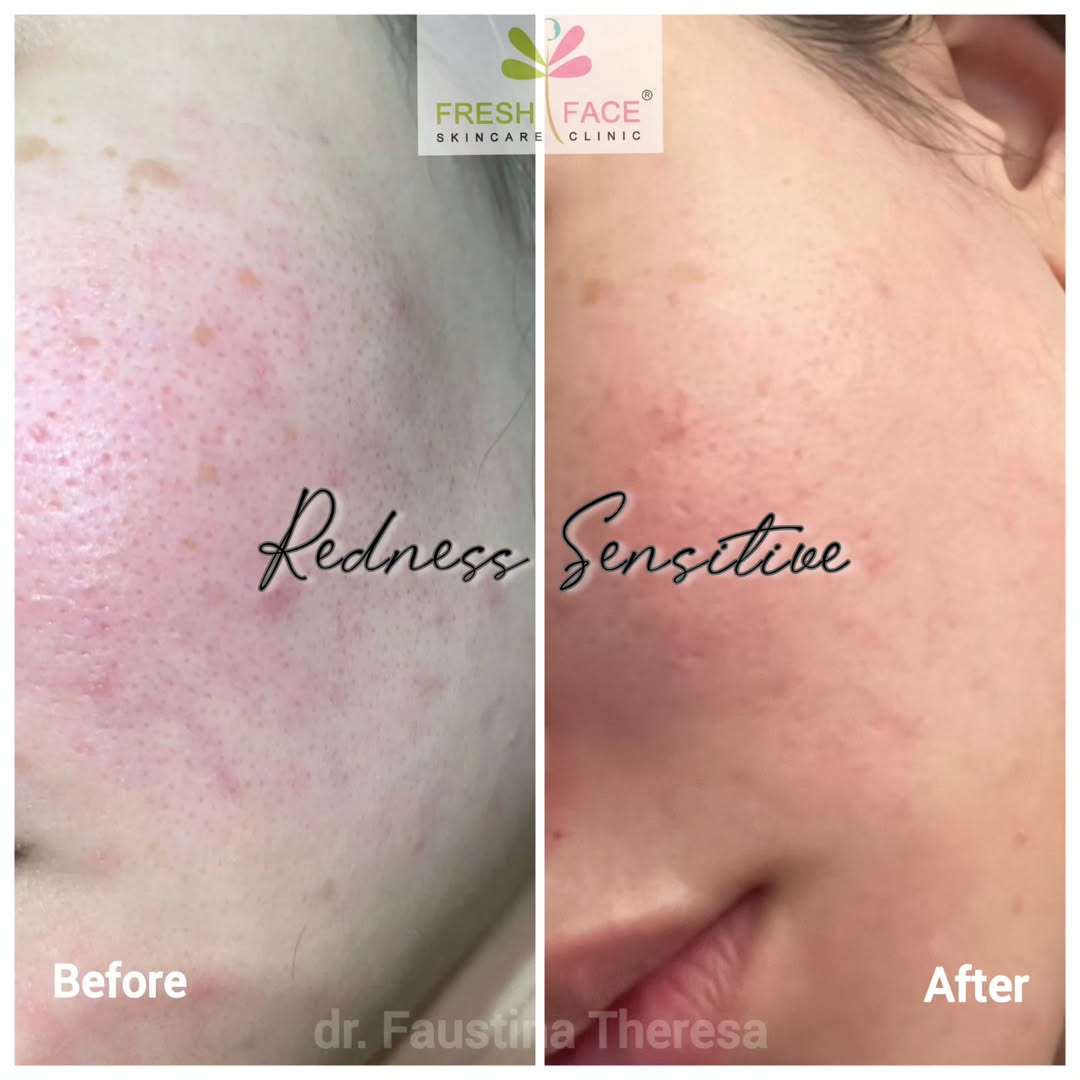 Rosasea Treatment
