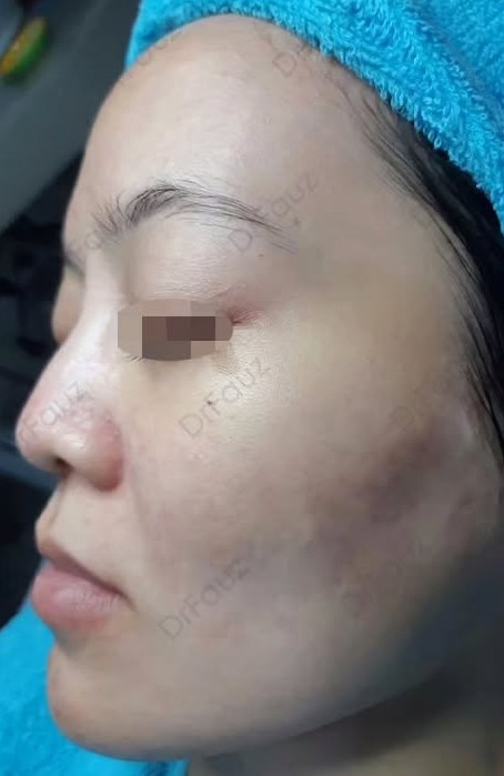 After Acne