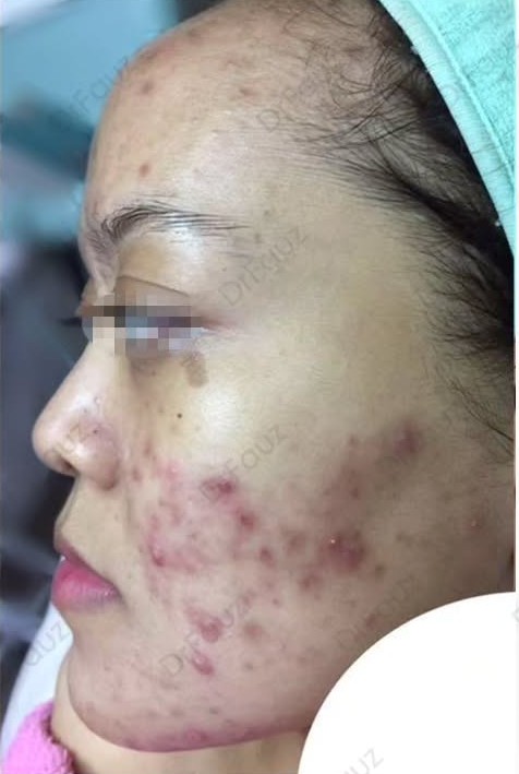 Before Acne